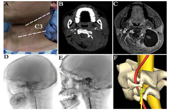 Vertebral Artery Dissection Rupture in a Patient with Varicella Zoster Virus Infection after  Cervical Spine Manipulation: Case and Review of the Literature