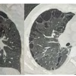 Recurrent Spontaneous Pneumothorax Revealing Neurofibromatosis Type 1 Lung Disease