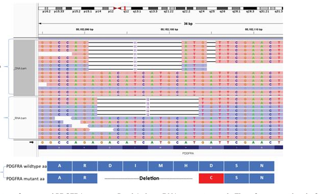 An Unusual PDGFRA Mutation in Gastrointestinal Stromal Tumor and Its NGS  Data Analysis