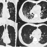 A 57-Year-Old Man with Mycobacterium Mageritense and Pneumocystis Jirovecii Coinfection after Loss to Follow-Up for 9 Years