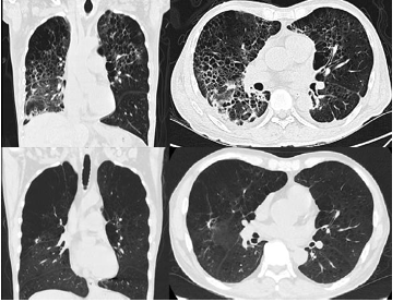 A 57-Year-Old Man with Mycobacterium Mageritense and Pneumocystis Jirovecii Coinfection after Loss to Follow-Up for 9 Years