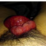 Vaginal Vault Dehiscence and Postoperative Evisceration: Case Report