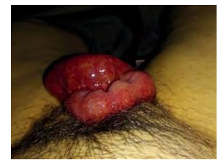 Vaginal Vault Dehiscence and Postoperative Evisceration: Case Report