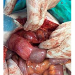 Appendiceal Mucocele: Management of This Rare Entity Cases Report and Review  of Literature