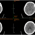 Treatment For Thrombocytopenia Complicated with Intracranial Venous Sinus Thrombosis and Bleeding with Eltrombopag: A Case Report