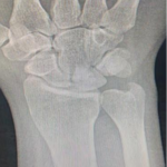 Isolated Lunate Fracture Nonunion: A Case Report of Chronic Wrist Pain in a 37  Years Old Male