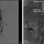 Splenic Artery Aneurysm