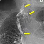 Endovascular Superior Vena Cava Stenting As Effective Therapy of A Life Threatening  Epistaxis in A Patient with Hereditary Hemorrhagic Telangiectasia