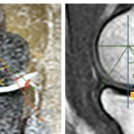 The Mooji Effect of “Osborne-Cotterill Lesion” New Approach to Concept