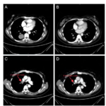 A Case Report of Locally Advanced Non-Small Cell Lung Cancer Treated with Lorlatinib  to Achieve R0 Resection