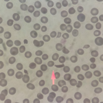 Analysis of Clinical Factors in First Diagnosis of Immune Thrombotic Thrombocytopenic  Purpura with Report of 6 Cases