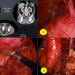 Laparoscopic Resection of Perineural Obturator Cystic