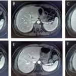 Trastuzumab Deruxtecan (T-Dxd) Combined with Local Therapy for Treatment of HR+/HER2+  Metastatic Breast Cancer with Liver and Distant Lymph Node Involvement: A Case Report