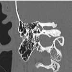 A Rare Case Report: Meniere Disease with Bilateral Internal Acoustic Canal Osteomas