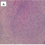 Kaposi’s Sarcoma in The Democratic Republic of Congo: Immunohisto-Chemical  Expression and Proliferative Activity in Different Histological Types