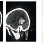 A Case Report of Pineal Germinoma Apoplexy