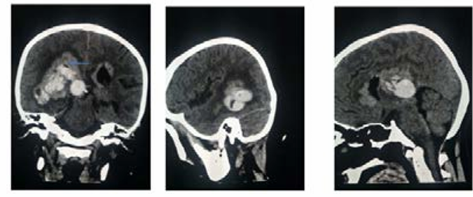 A Case Report of Pineal Germinoma Apoplexy