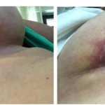 Immunological Abnormalities and Anaplastic Large Cell Lymphoma Associated with Breast Implant