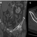 Aortic Endograft and Femoro-Femoral Bypass in A Patient with Acute Aortic Oclusion Post  Covid Respiratory Desease, Atrial Fibrilation and Vocal Cord Cancer with Chronic Left  External Iliac Oclusion