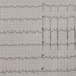 A 69-Year-Old Woman with Diabetes Presenting with Acute Dyspnea