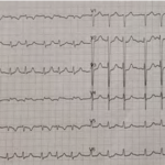 A 69-Year-Old Woman with Diabetes Presenting with Acute Dyspnea