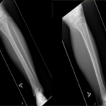 Using Musculoskeletal Ultrasound to Identify A Tibial Metadiaphysis Stress Fracture:  A Case Report