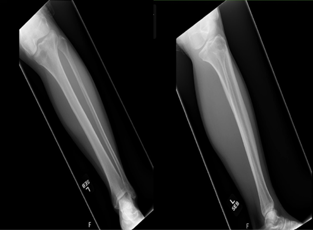 Using Musculoskeletal Ultrasound to Identify A Tibial Metadiaphysis Stress Fracture:  A Case Report