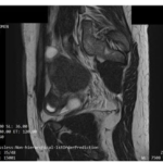 Atherosclerotic Coronary Artery Disease-Mimicking Myocardial Bridging