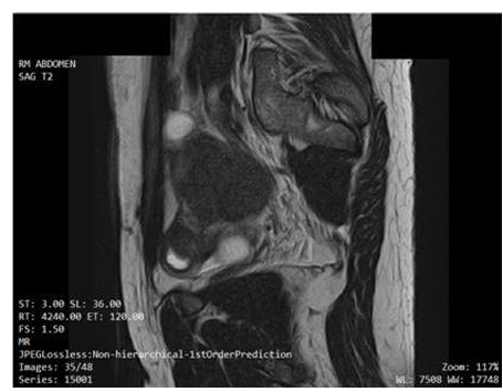 The Buerger’s Disease and the Cryoglobulinemia, the Same Old Love?