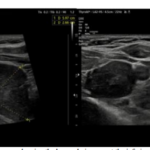 Giant ParathyroidAdenoma Causing Severe Primary Hyperparathyroidism: A Case Report