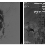 Splenic Artery Aneurysm