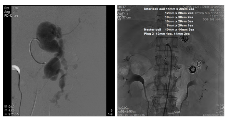 Splenic Artery Aneurysm