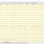 A Case Report of a Diagnosis Challenge: Hot Water Epilepsy and Anxiety Disorder