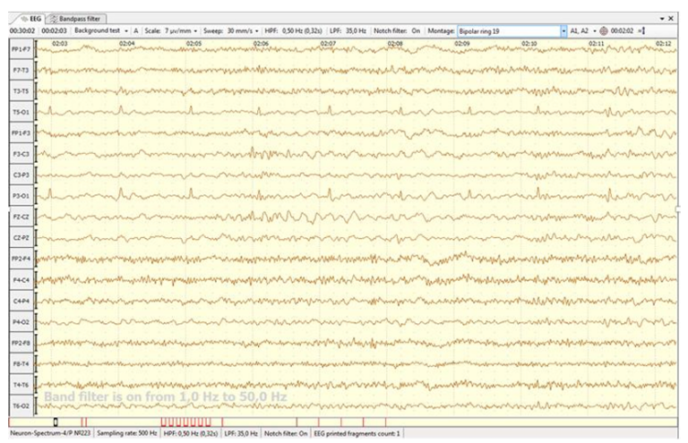 A Case Report of a Diagnosis Challenge: Hot Water Epilepsy and Anxiety Disorder