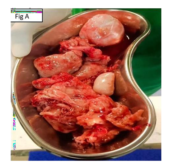 STUMP- A Challenging Differential Diagnosis and Therapeutic Dilemma