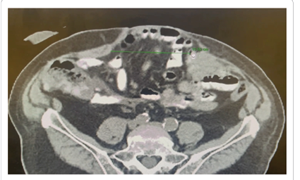 Concomitant Repair of Parastomal Hernia in the Presence of Midline Ventral  Hernia. How Do I Do It?