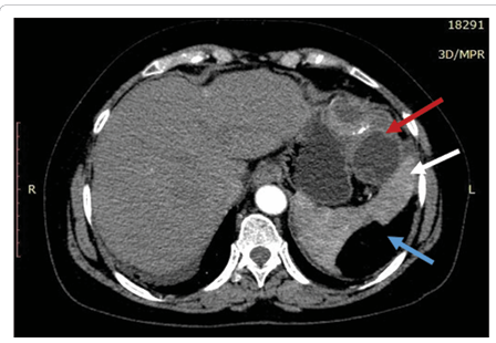 Recurrent Primary Isolated Hydatid Cyst of Spleen with Giant Splenic Lipoma  Mimicking Liposarcoma: A Case Report