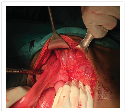 Rare Idiopathic Ileocecal Colic Intussusception in Adult with Delayed  Presentation: A Case Report