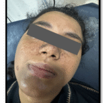 Spontaneous Renal Rupture Revealing Tuberous Sclerosis Complex: A Case Report
