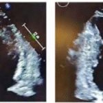 A Rare Case of Mid-Ventricular and Apical Hypertrophic Cardiomyopathy with Hourglass Appearance on Echocardiogram