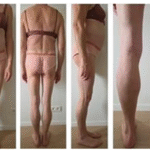 A Case of Familial Partial Lipodystrophy Type 3 with A Novel Pparg Variant of  Unknown Significance