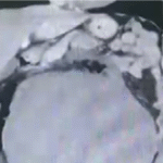 Giant Uterine Leiomyoma Associated with Erythrocytosis: First Reported Case in Peru