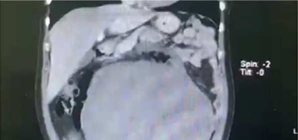Giant Uterine Leiomyoma Associated with Erythrocytosis: First Reported Case in Peru
