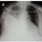 Non-Purulent Empyema Salmonellosis in an Elderly Patient with Heart Failure: A  Case Report and Literature Review