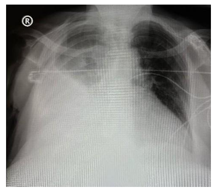 Non-Purulent Empyema Salmonellosis in an Elderly Patient with Heart Failure: A  Case Report and Literature Review