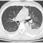 Atypical Esophageal Perforation: Clinical Vigilance and Nutritional Management – Case Report