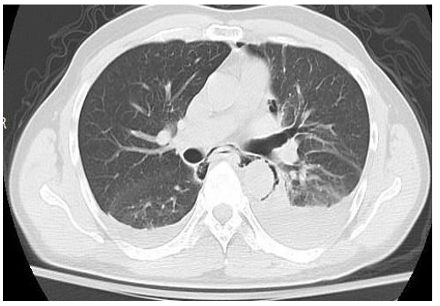Atypical Esophageal Perforation: Clinical Vigilance and Nutritional Management – Case Report
