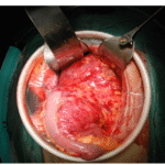 A Case Report of Hemolymphangioma of Mesentery in Adults