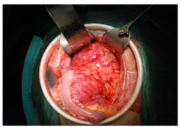 A Case Report of Hemolymphangioma of Mesentery in Adults