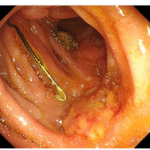 Duodenal Perforation by Inferior Vena Cava Filter. A Rare Cause of Recurrent  Abdominal Pain